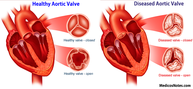 Healthy versus Diseased Aortic Valve